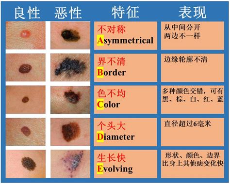 睪丸 黑痣|蘋果日報